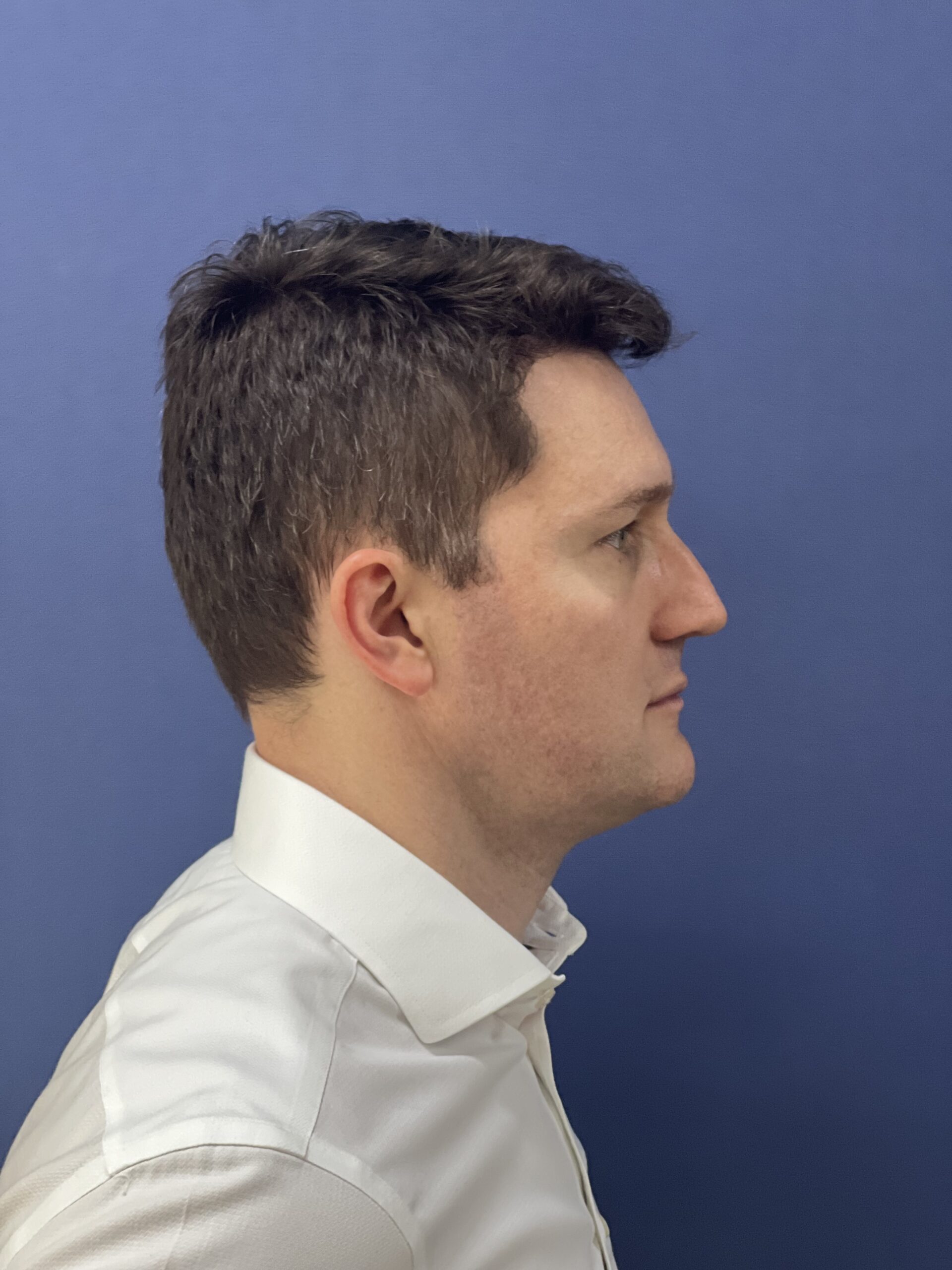 No-Shave FUE, 2300 grafts, photo 20 of 20