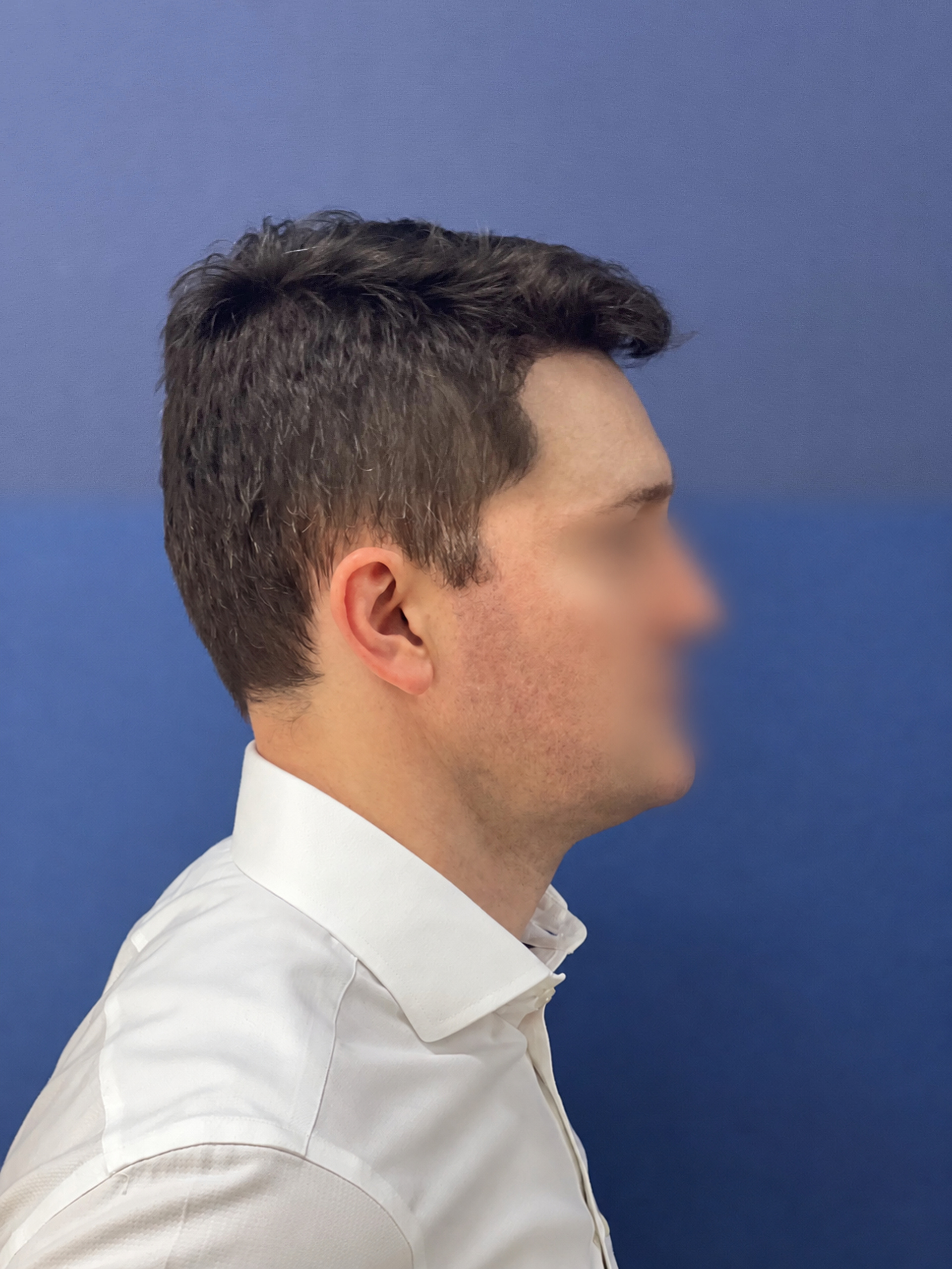No-Shave FUE, 2300 grafts, photo 20 of 20