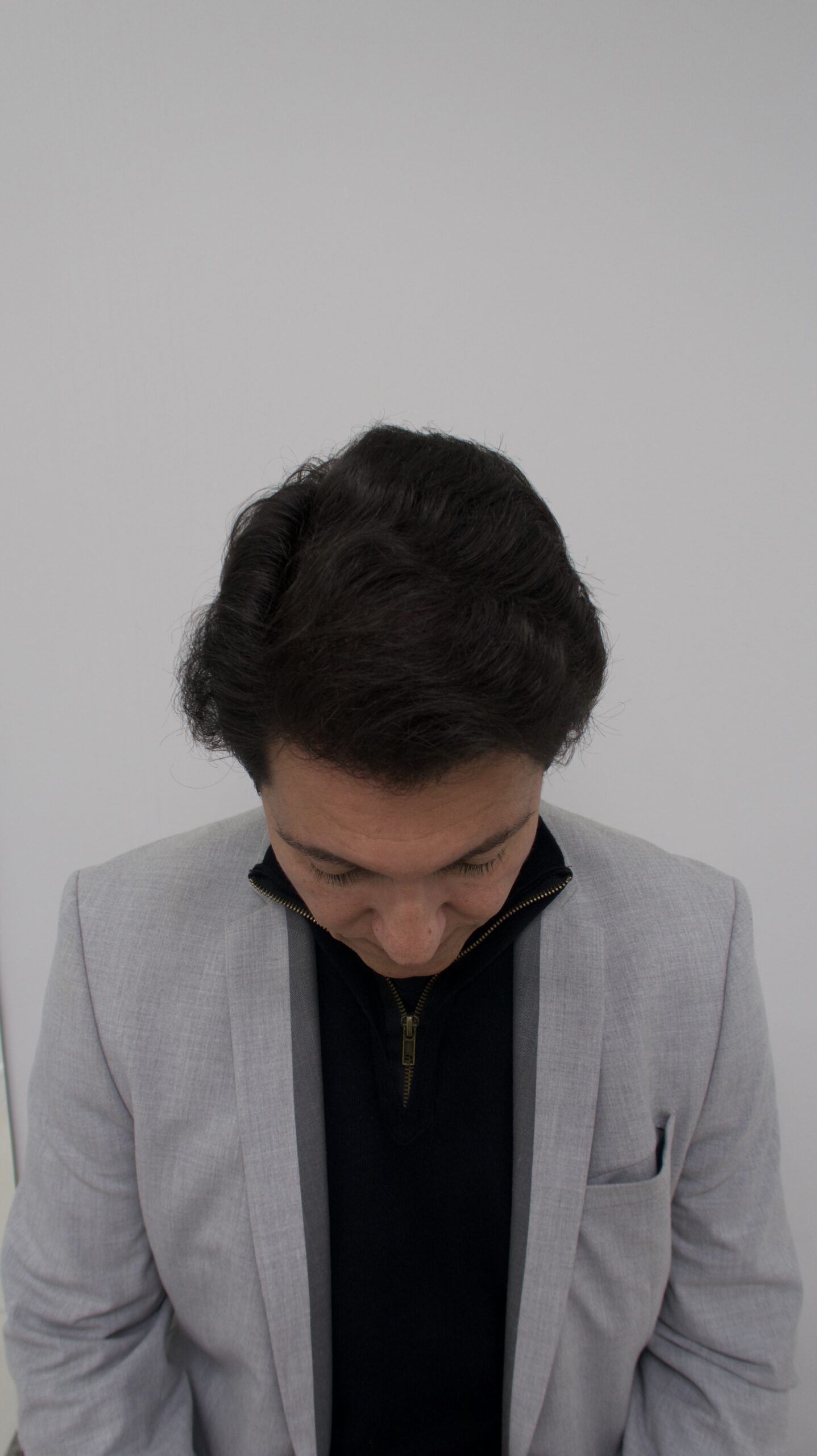 No-Shave FUE, 5000 grafts, photo 22 of 26