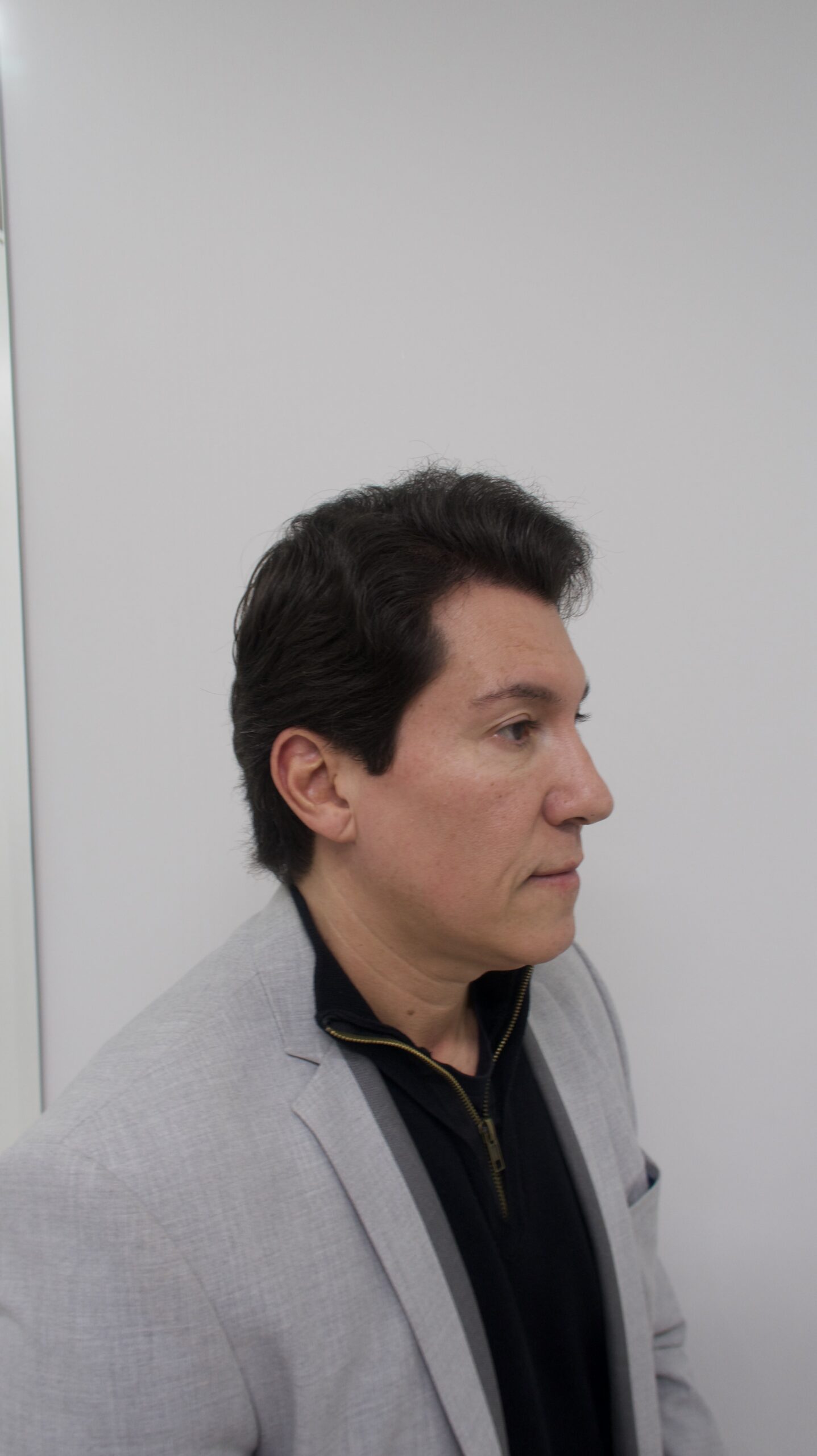 No-Shave FUE, 5000 grafts, photo 25 of 26