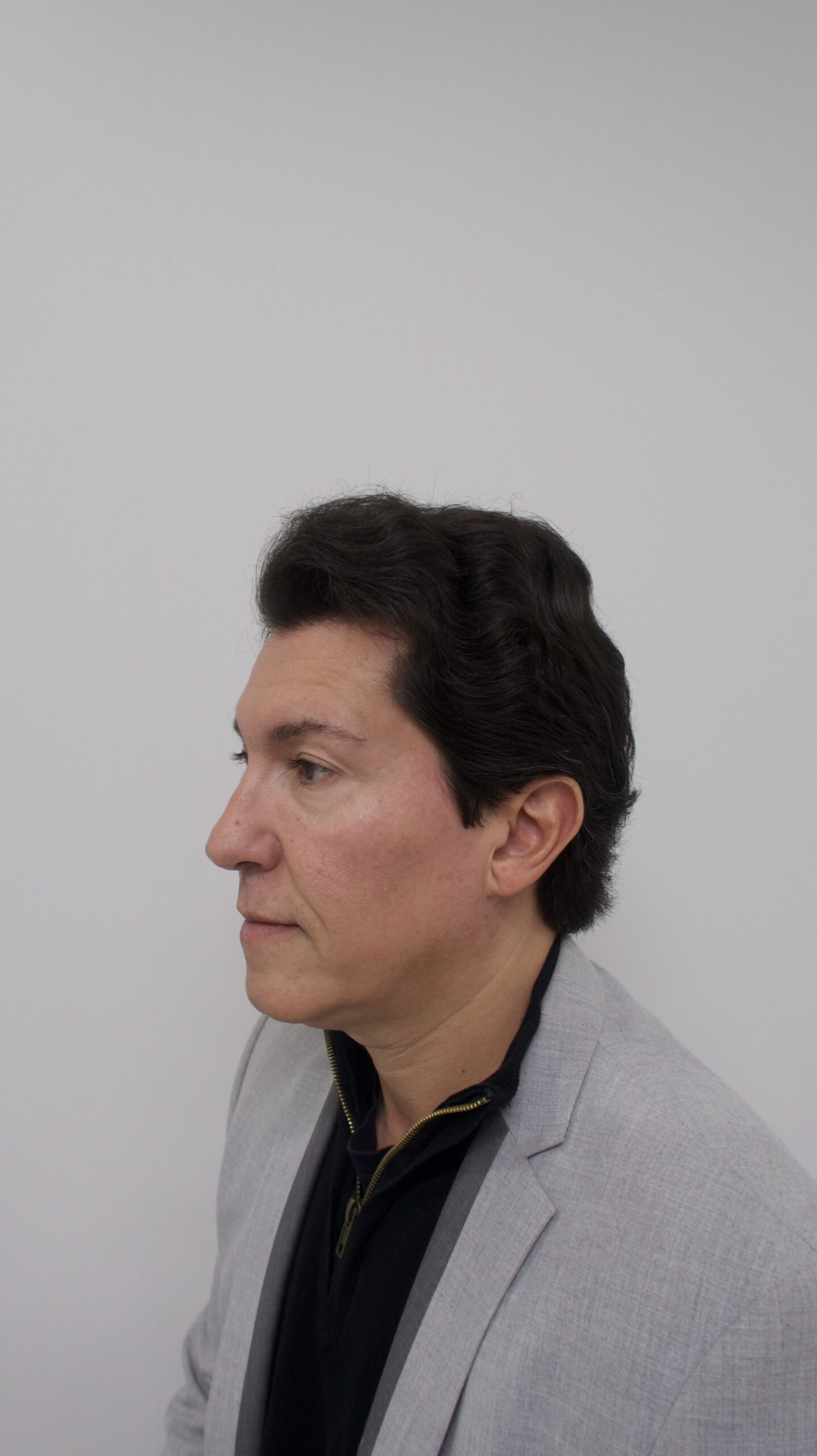 No-Shave FUE, 5000 grafts, photo 24 of 26