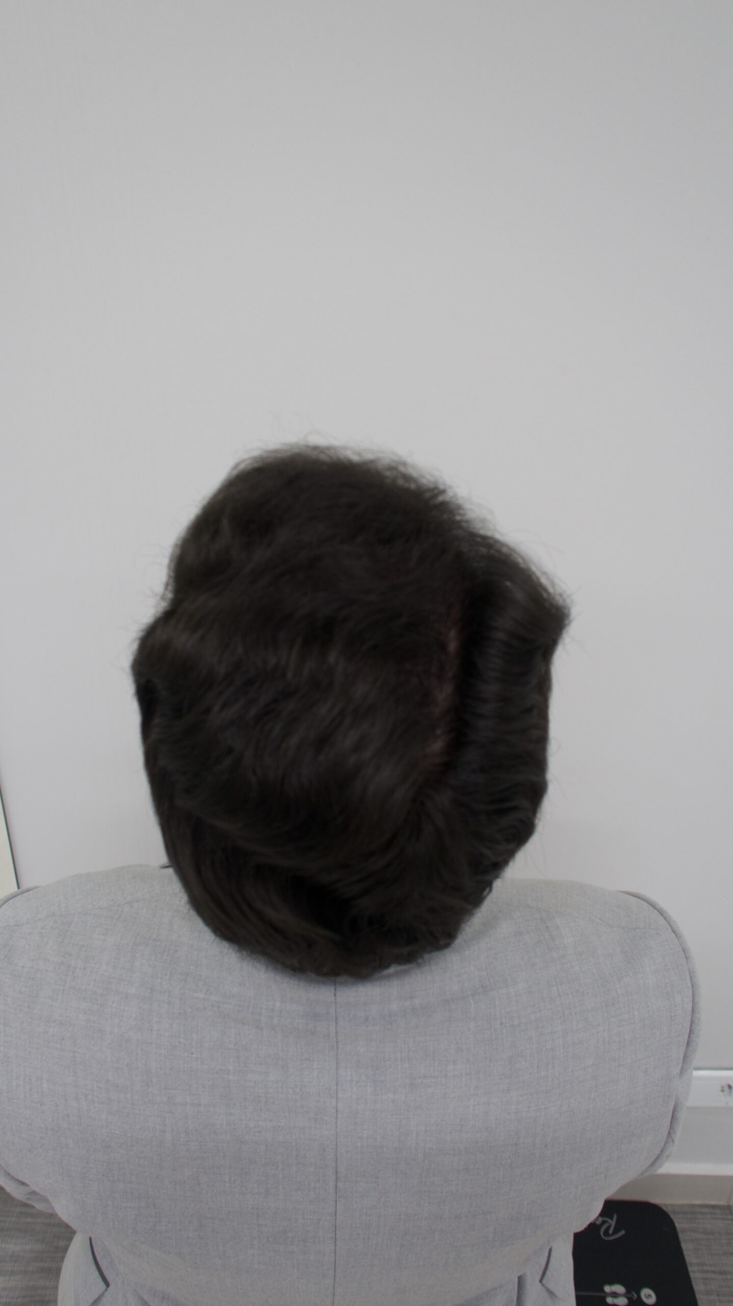 No-Shave FUE, 5000 grafts, photo 23 of 26
