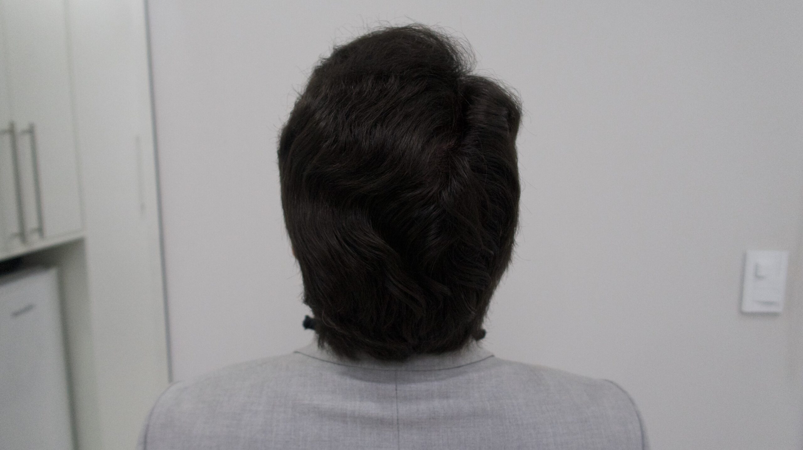 No-Shave FUE, 5000 grafts, photo 26 of 26