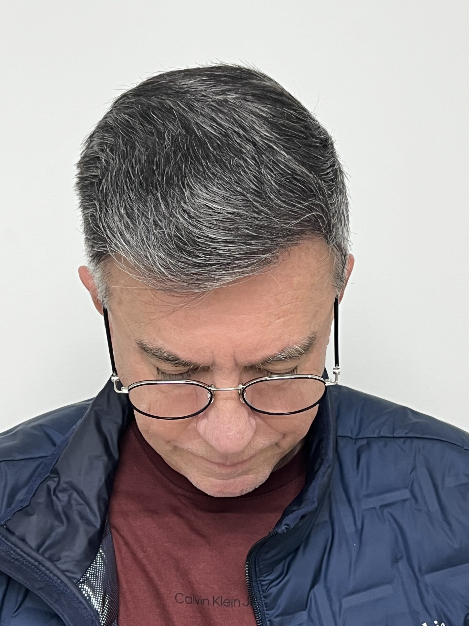 No-Shave FUE, 4000 grafts, photo 27 of 31