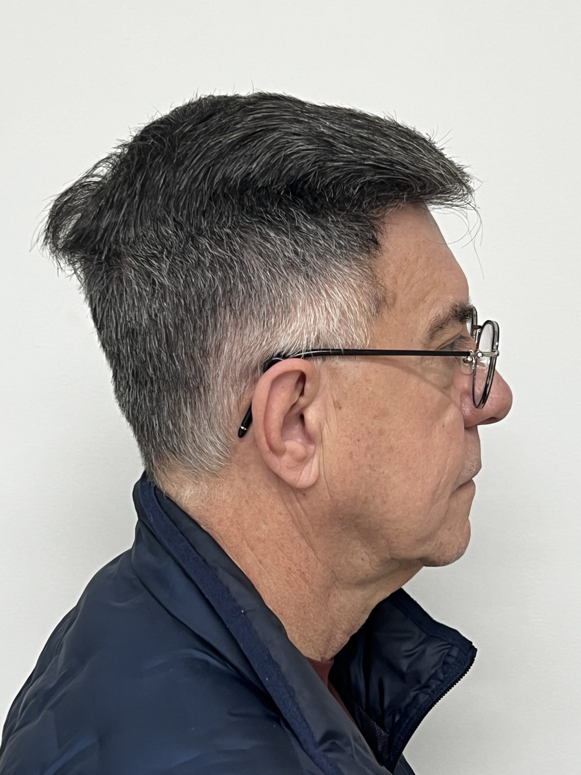 No-Shave FUE, 4000 grafts, photo 30 of 31