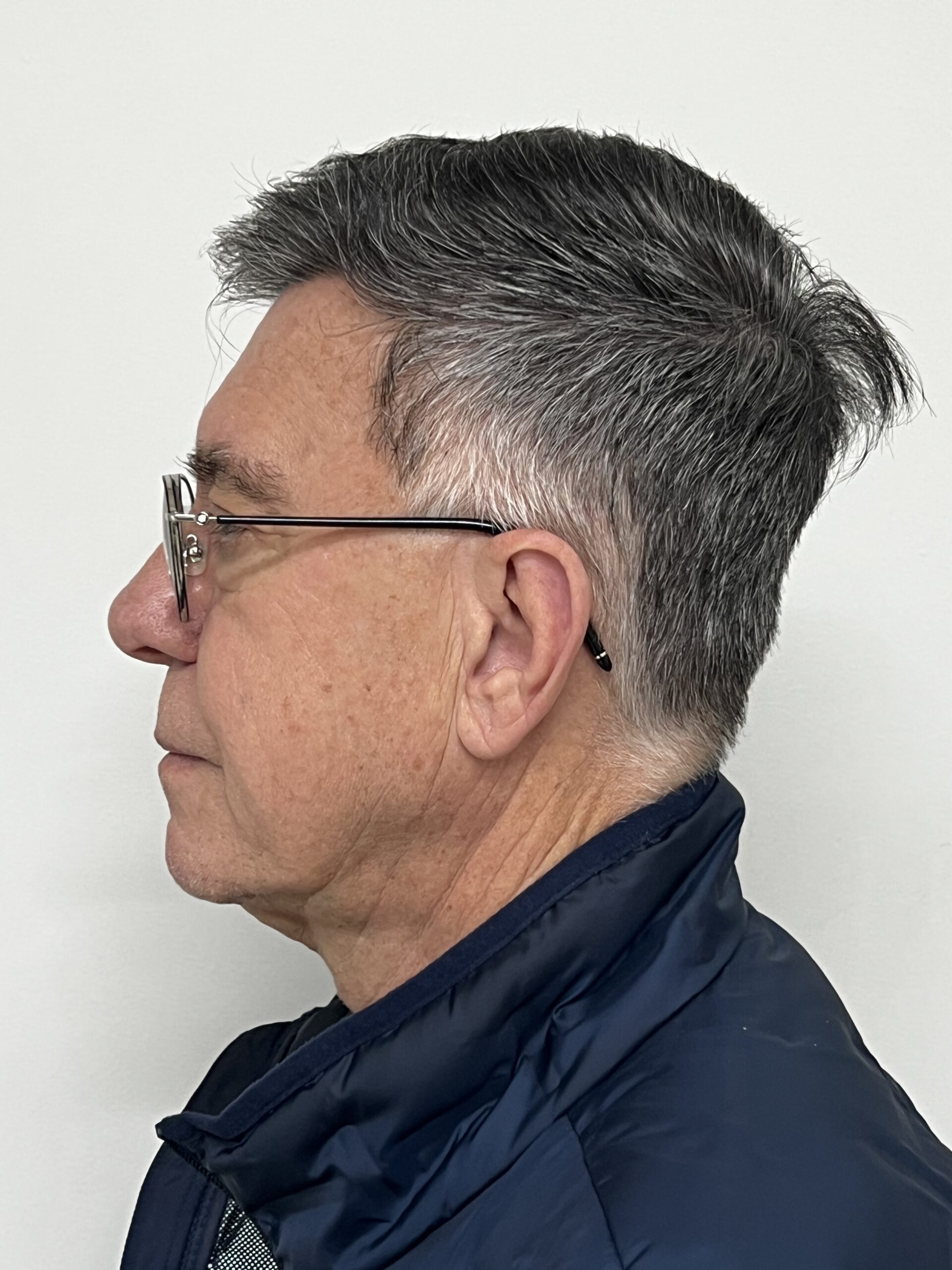 No-Shave FUE, 4000 grafts, photo 31 of 31