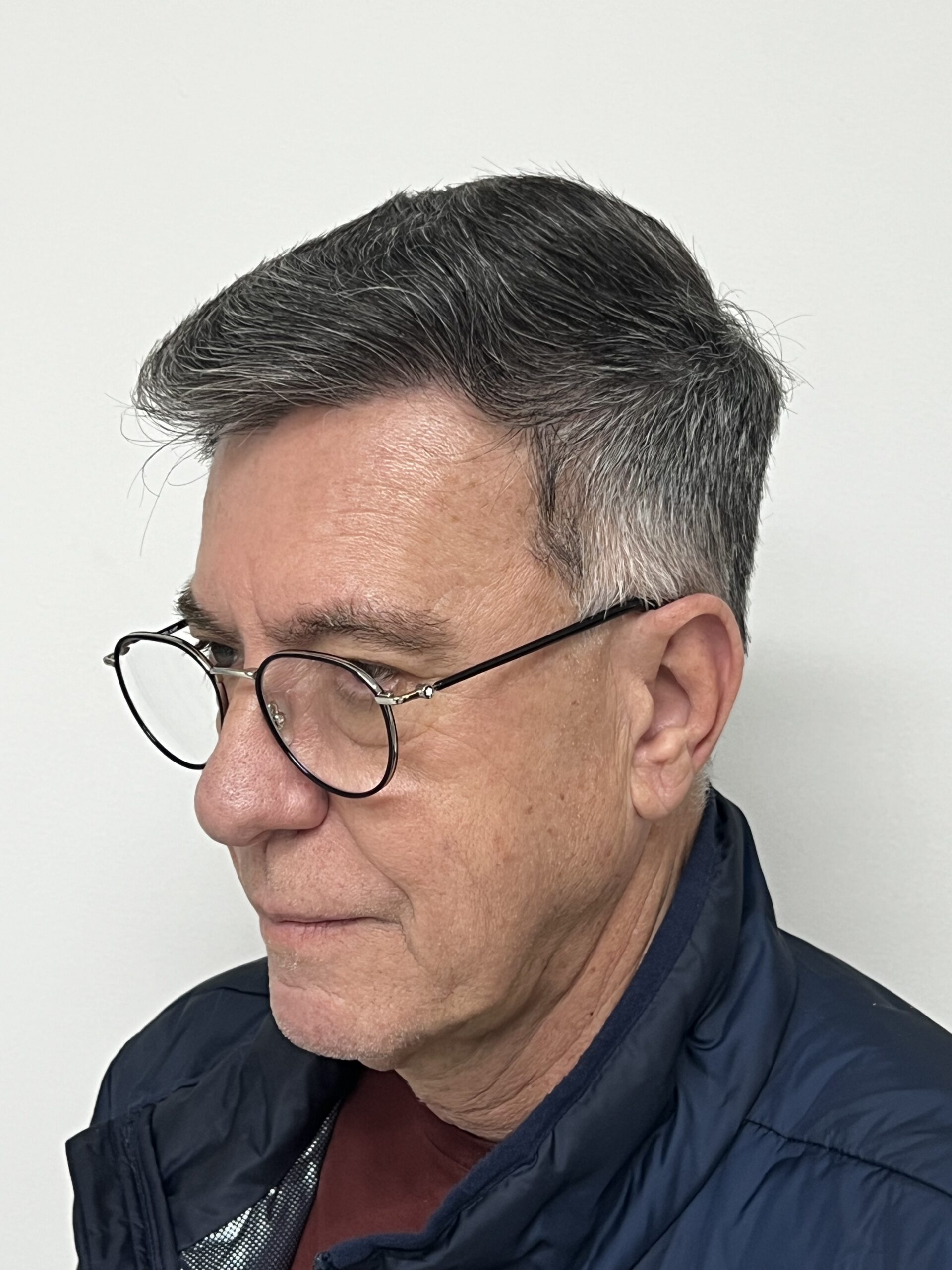 No-Shave FUE, 4000 grafts, photo 28 of 31