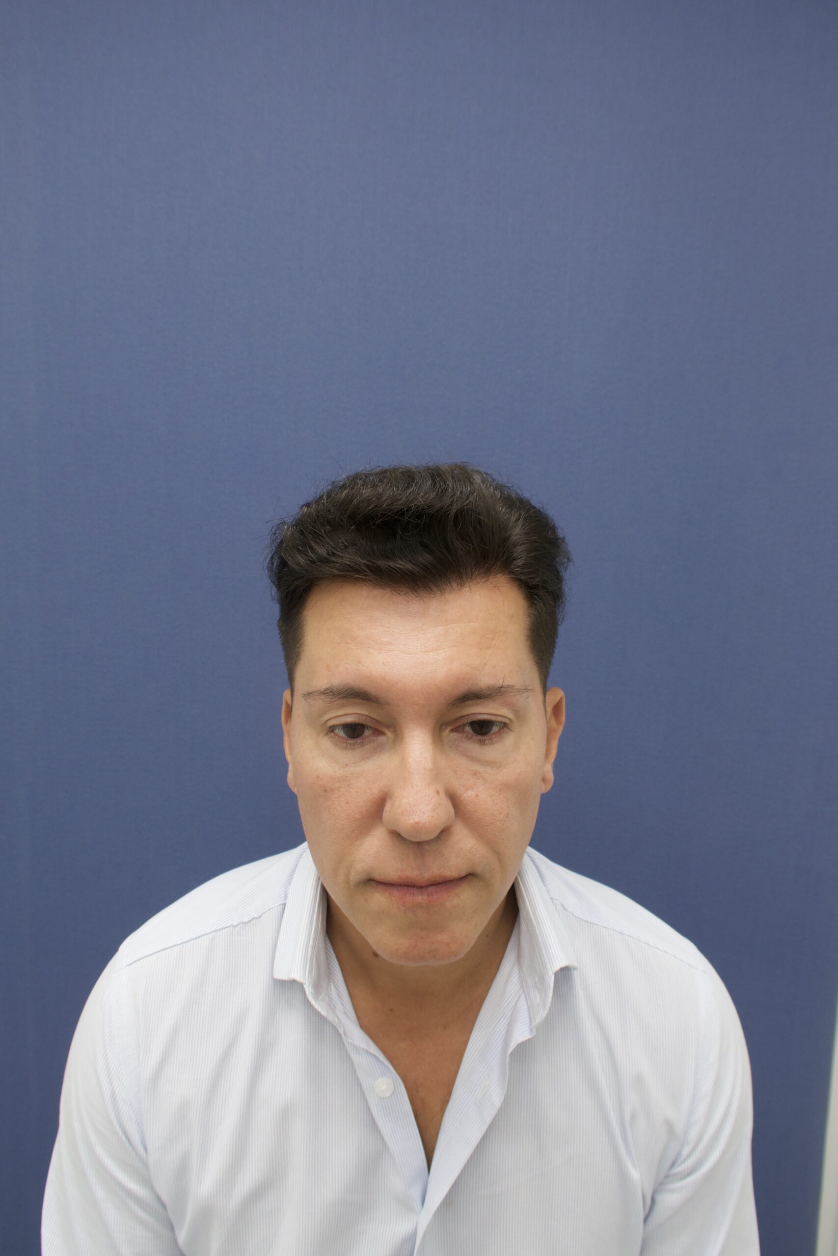 No-Shave FUE, 5000 grafts, photo 15 of 26