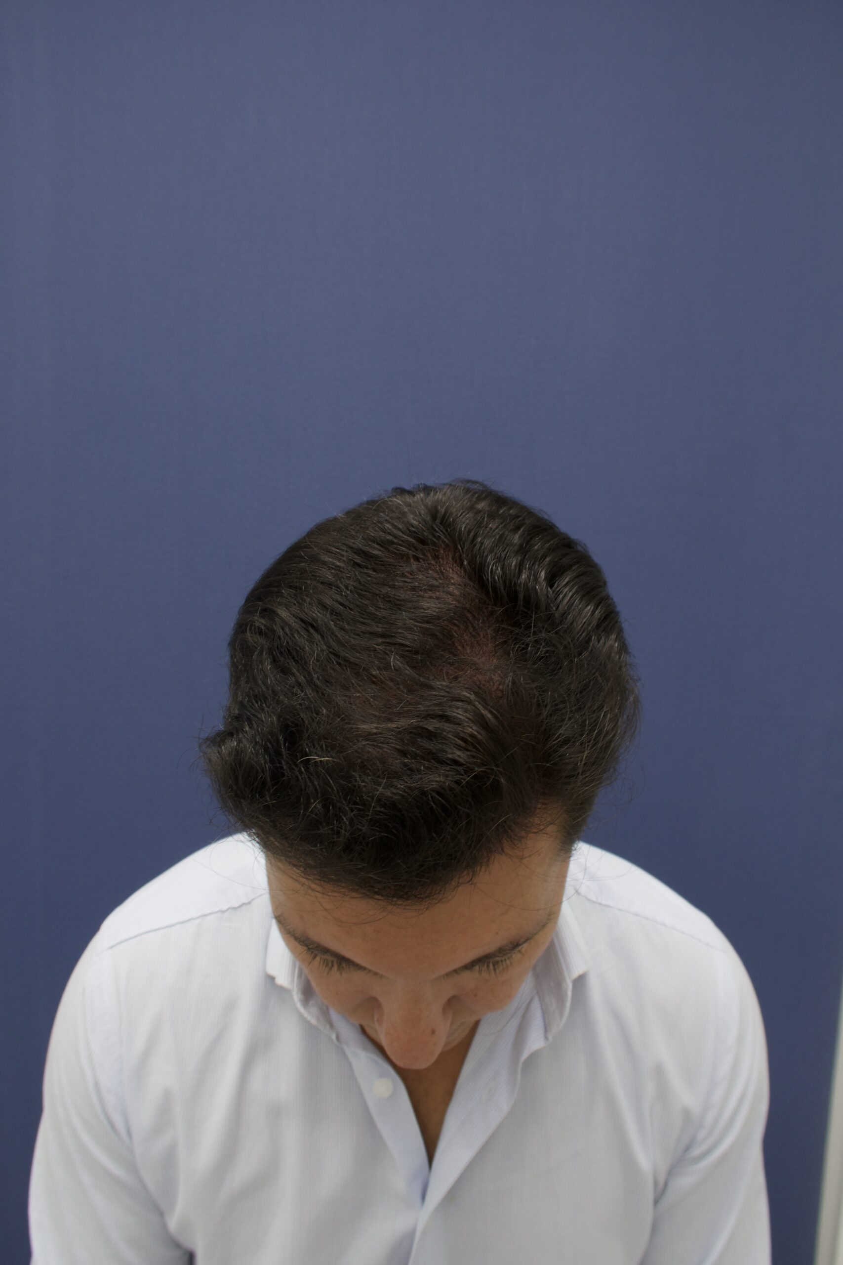 No-Shave FUE, 5000 grafts, photo 16 of 26