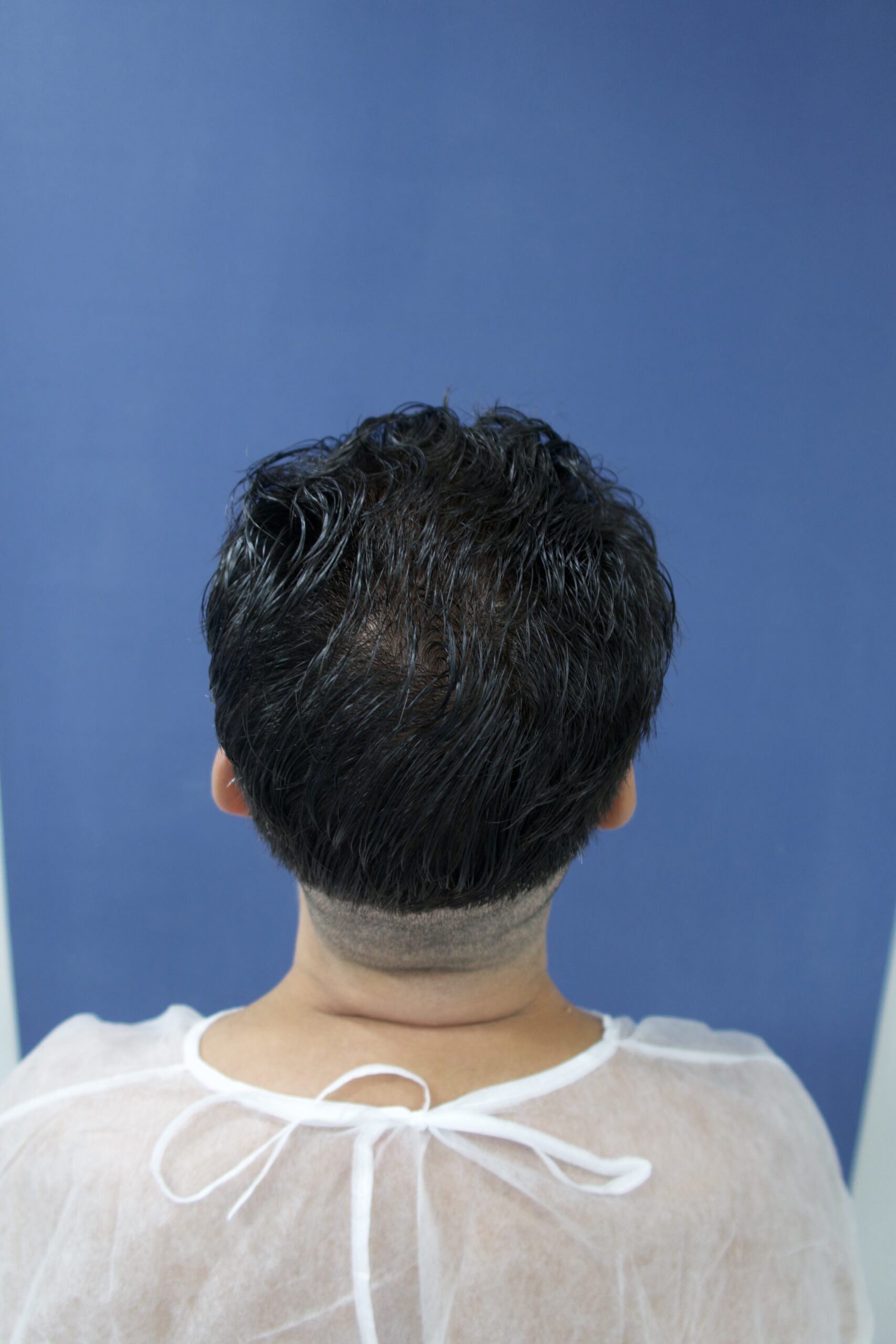 No-Shave FUE, 5000 grafts, photo 17 of 26