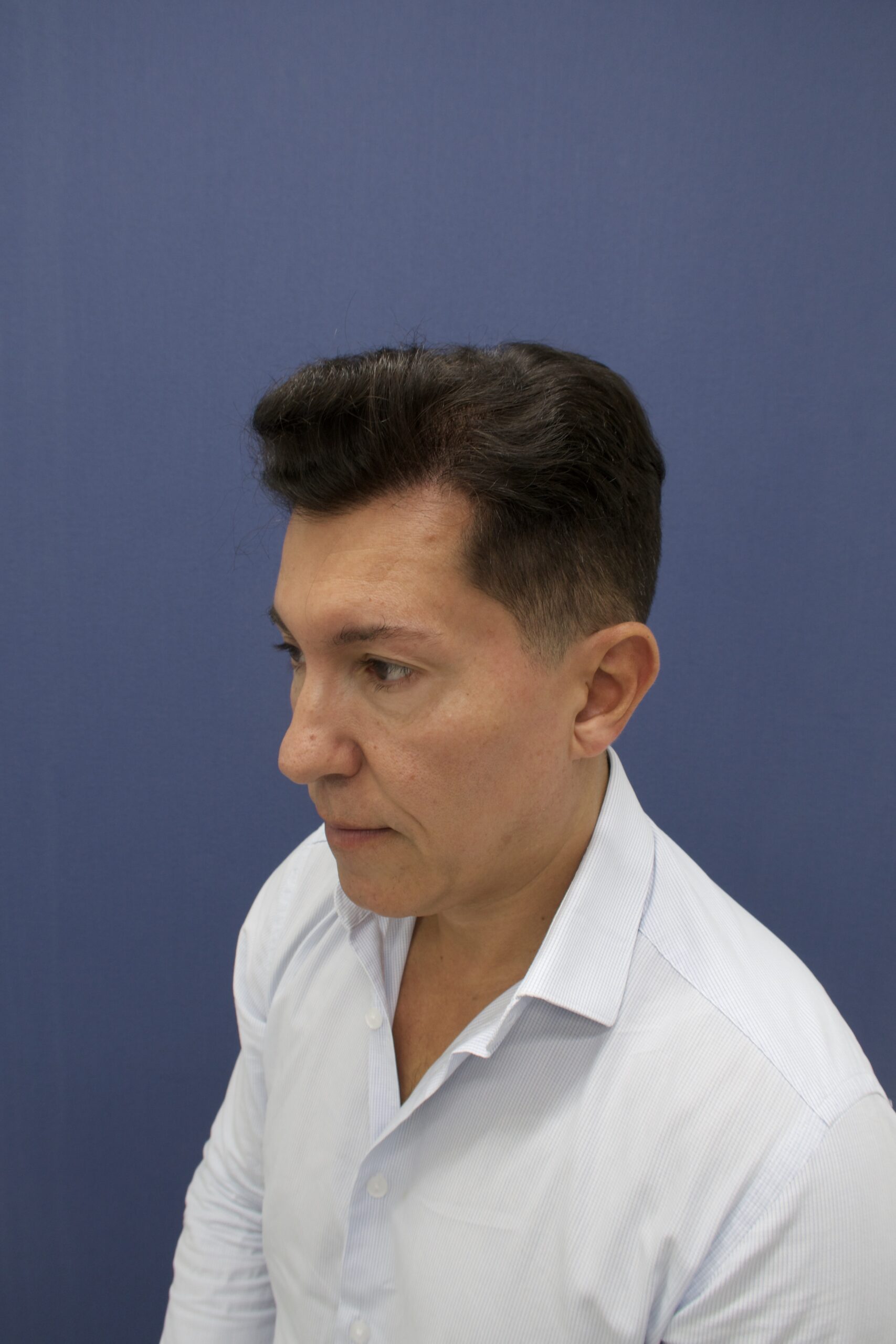 No-Shave FUE, 5000 grafts, photo 18 of 26