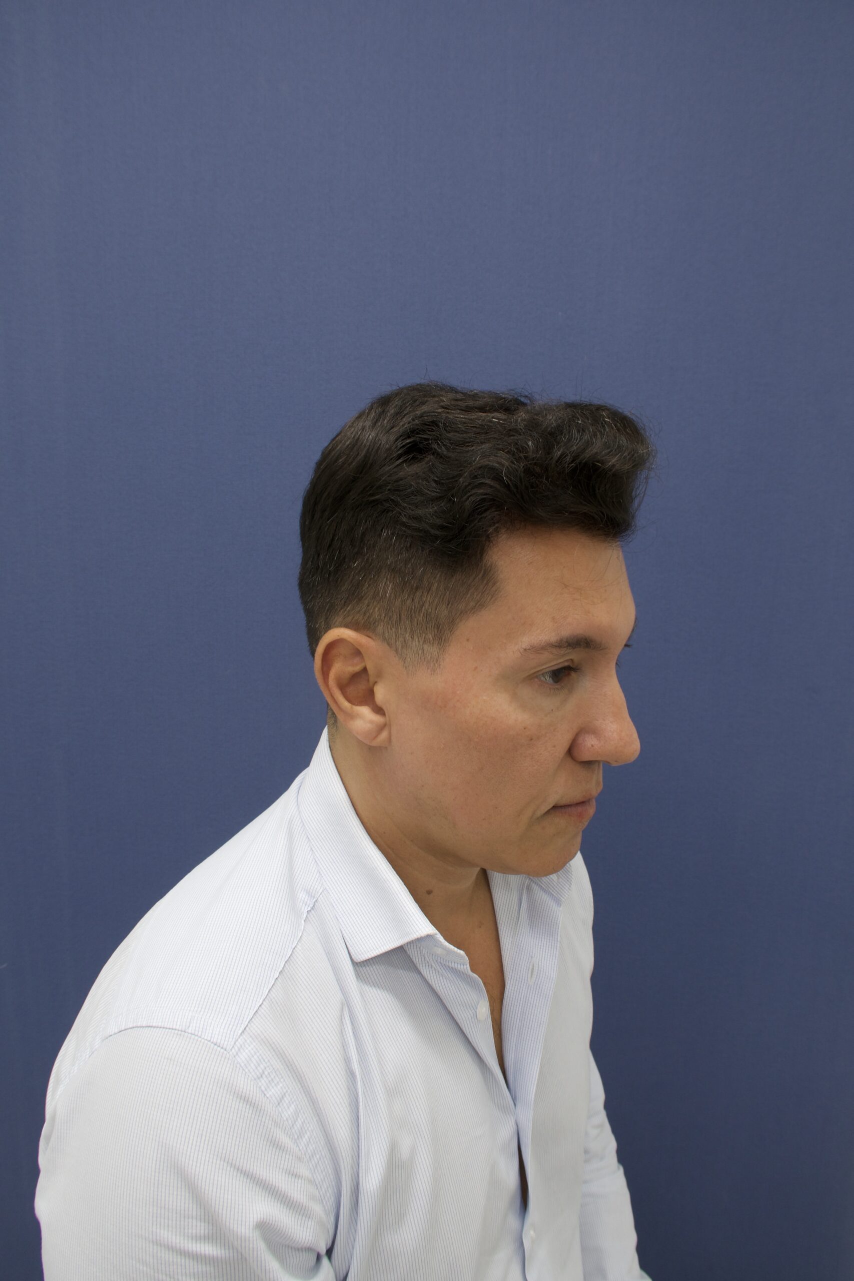 No-Shave FUE, 5000 grafts, photo 19 of 26