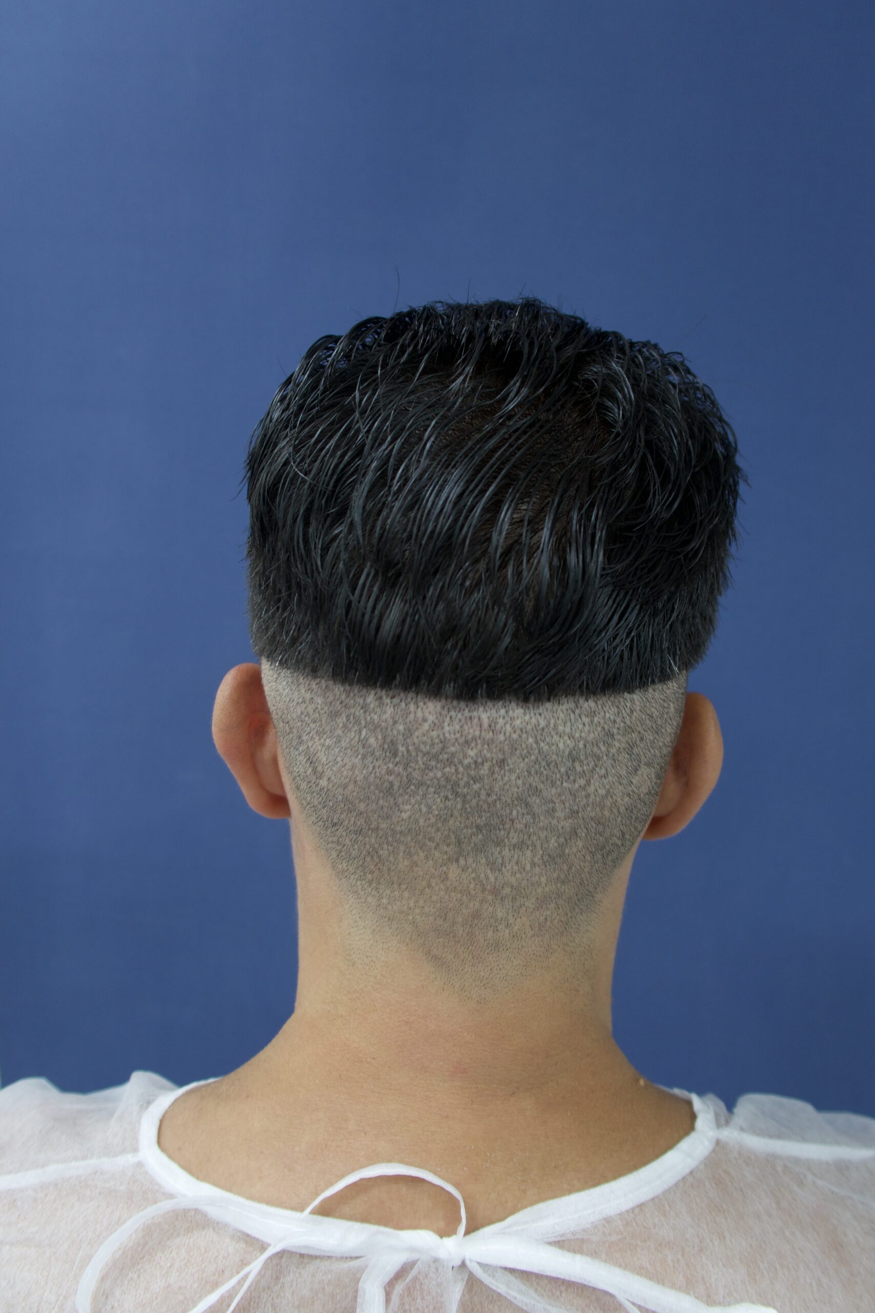 No-Shave FUE, 5000 grafts, photo 20 of 26