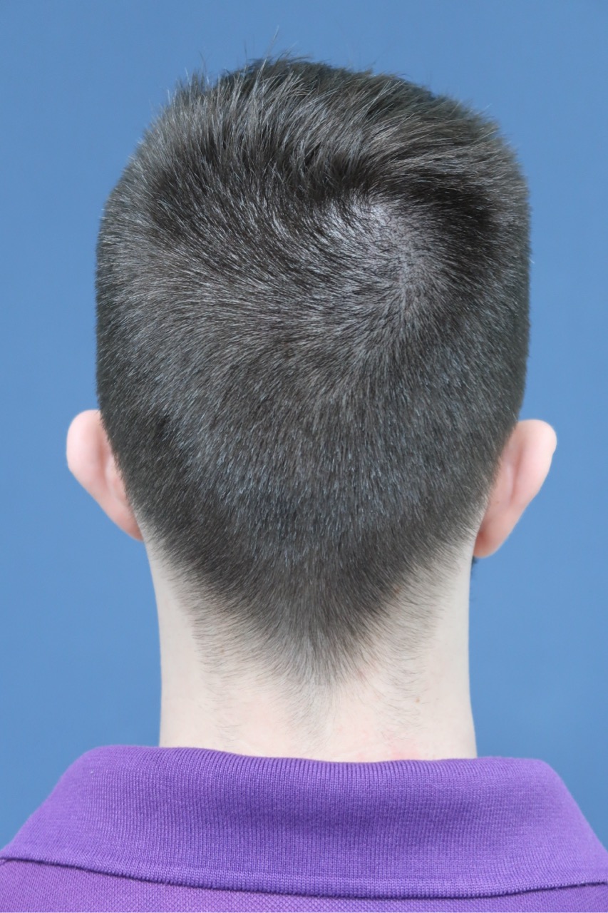 Back of the scalp showing the donor area