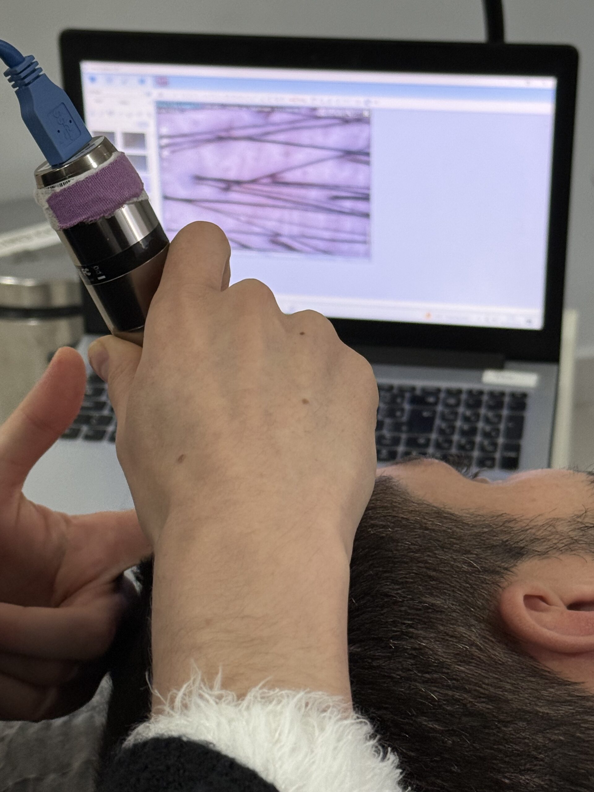 Trichoscopy device and magnified scalp image