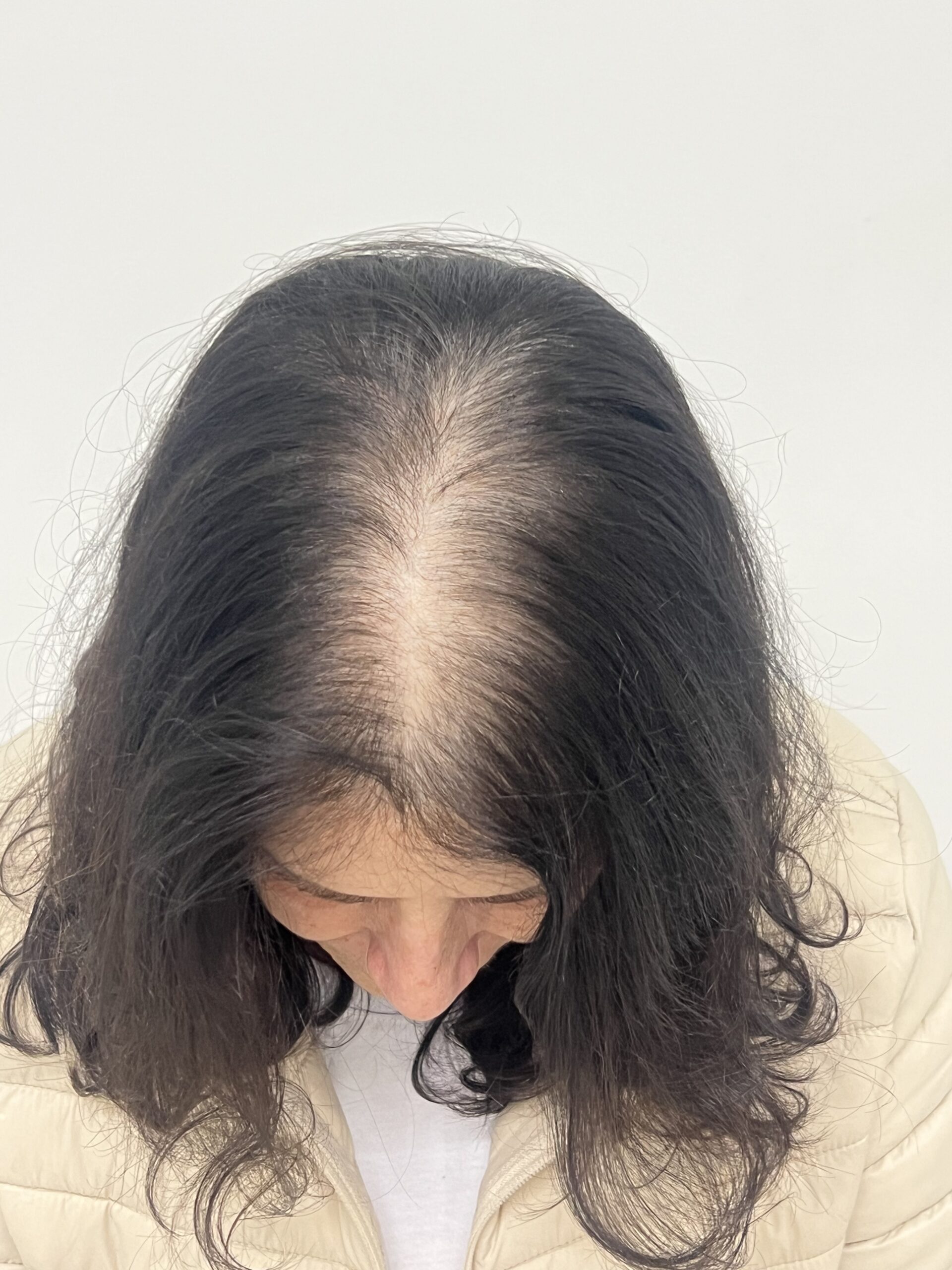 Female pattern hair loss