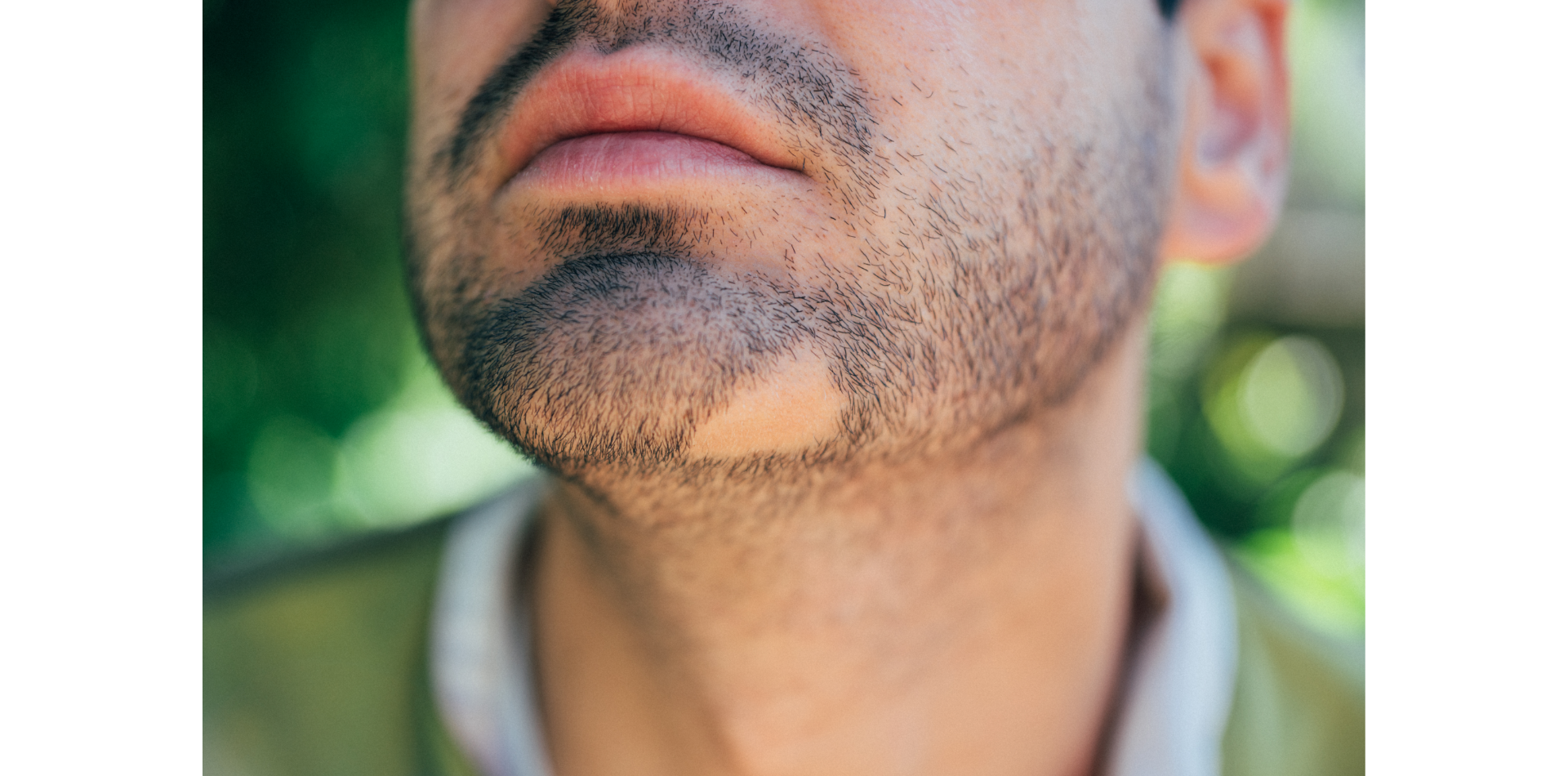 Alopecia areata in the beard area