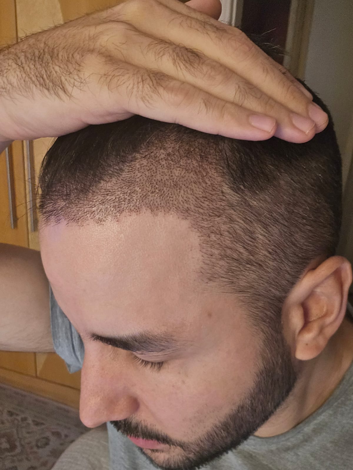 Hair growth after surgery