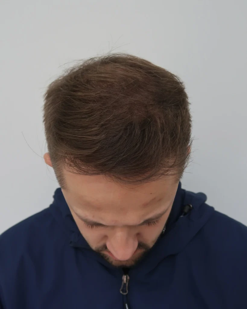 No-Shave FUE, 5000 grafts, after