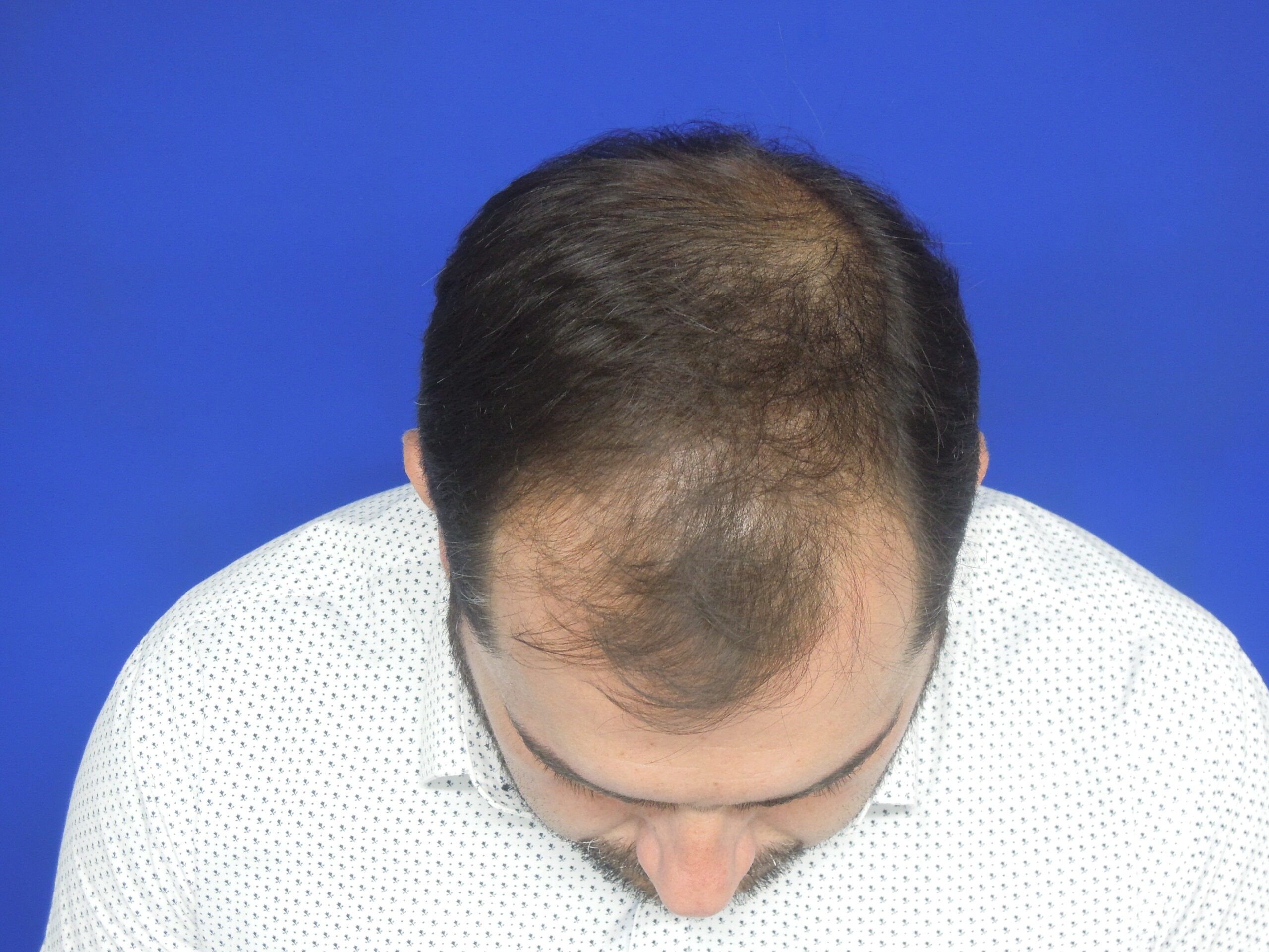 Male pattern hair loss