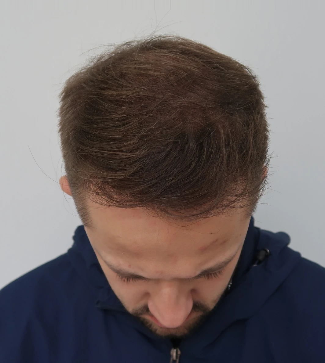 transplante-capilar-depois-alinhado-v4