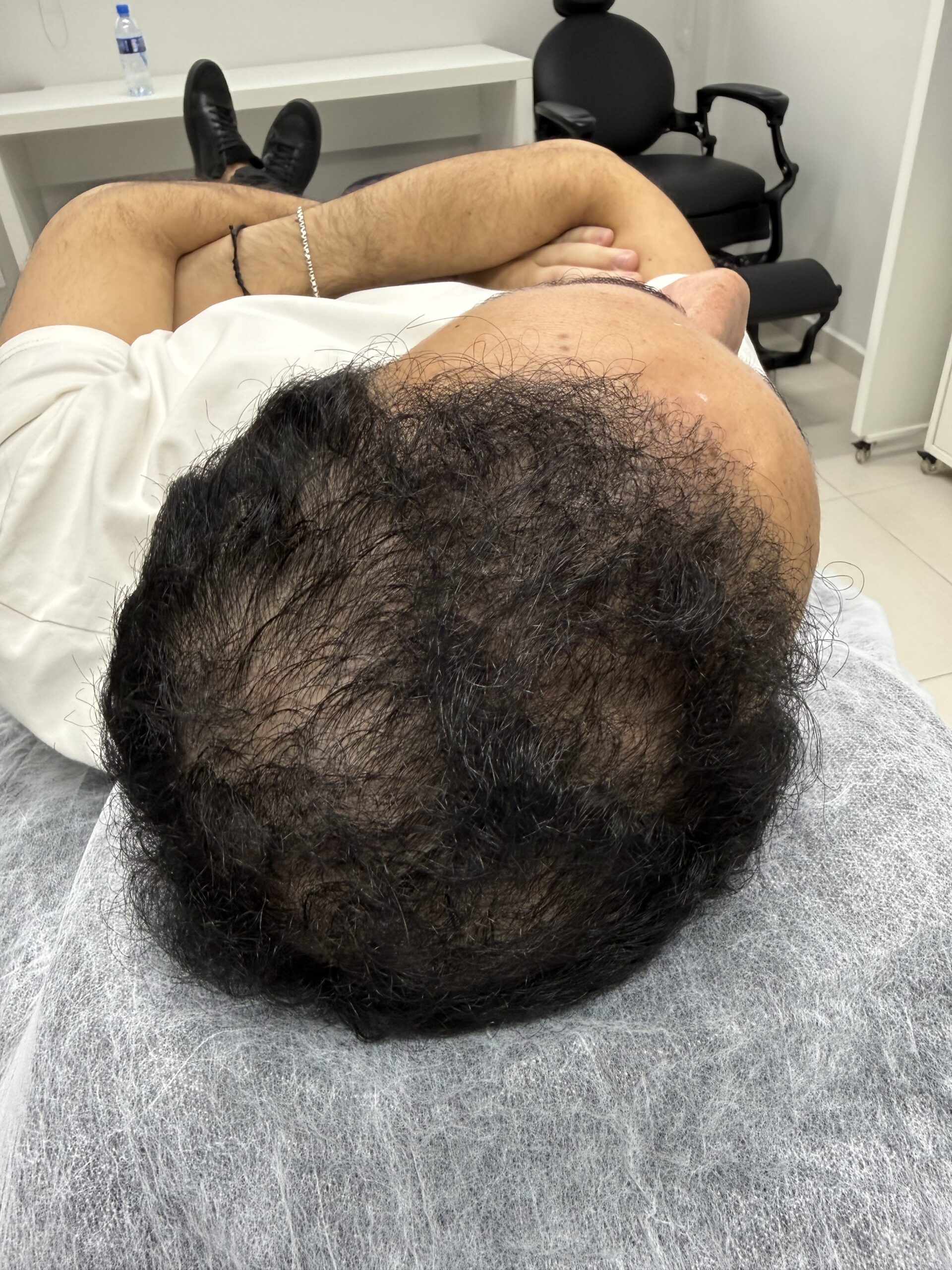 Close-up clinical photograph of hair thinning at the crown of the scalp