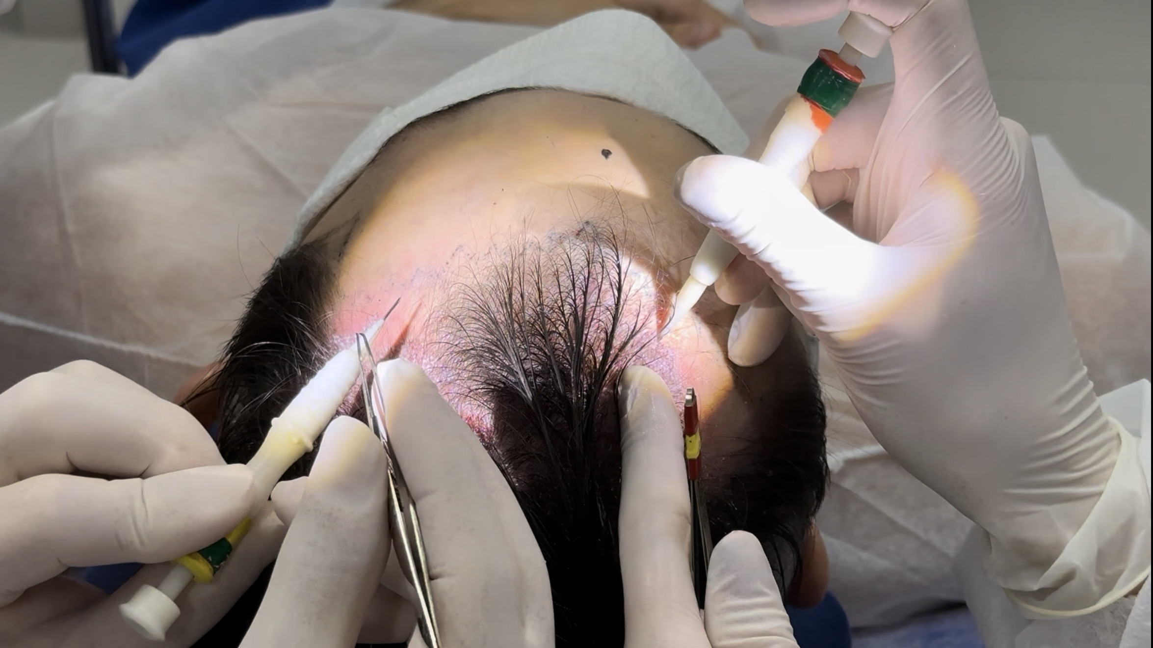 Visão clínica aproximada de canetas implantadoras usadas na implantação DHI de enxertos